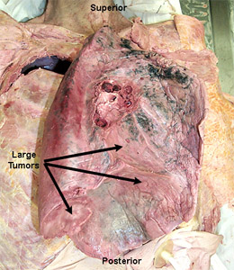 Non-small cell lung cancer